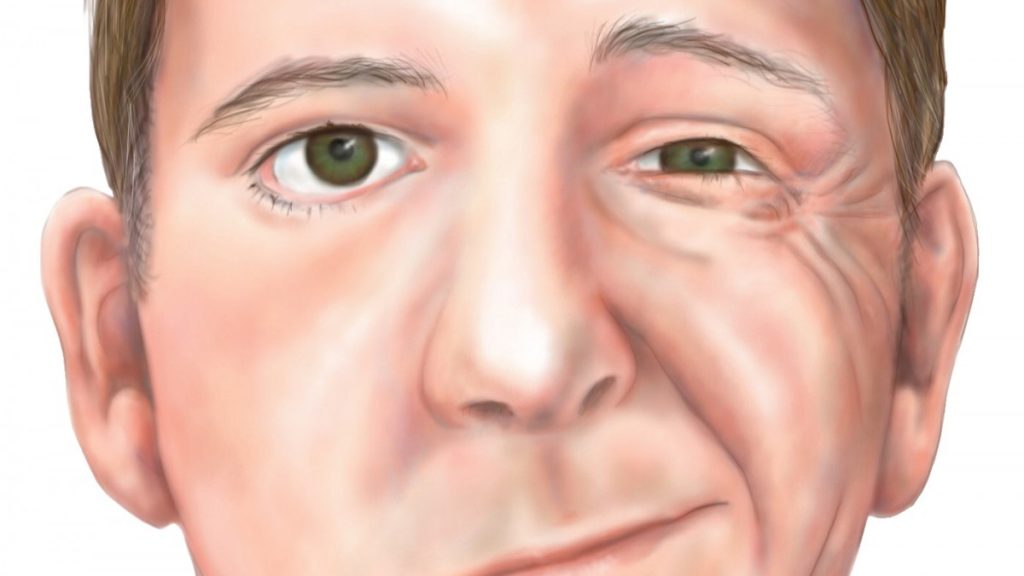 Bell's Palsy