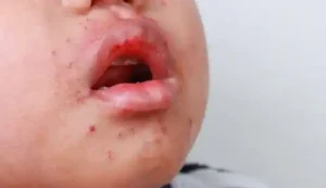 Campak Jerman Rubella