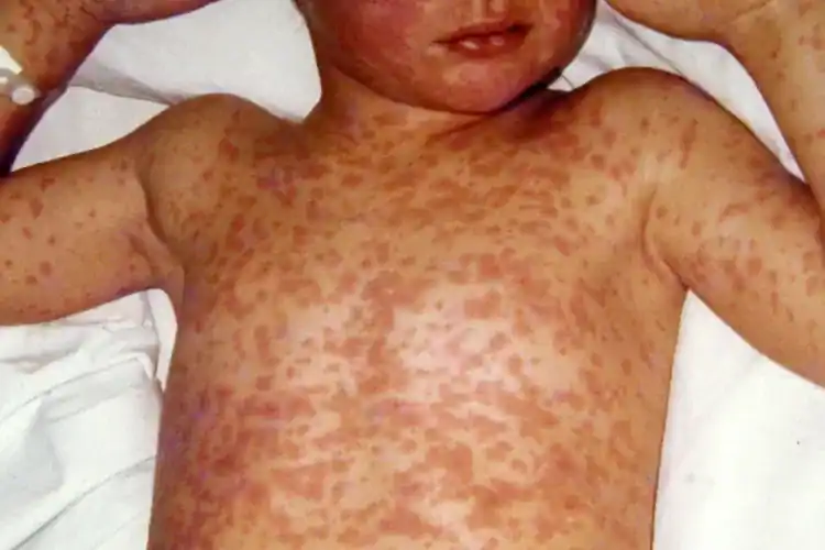 Campak Measles