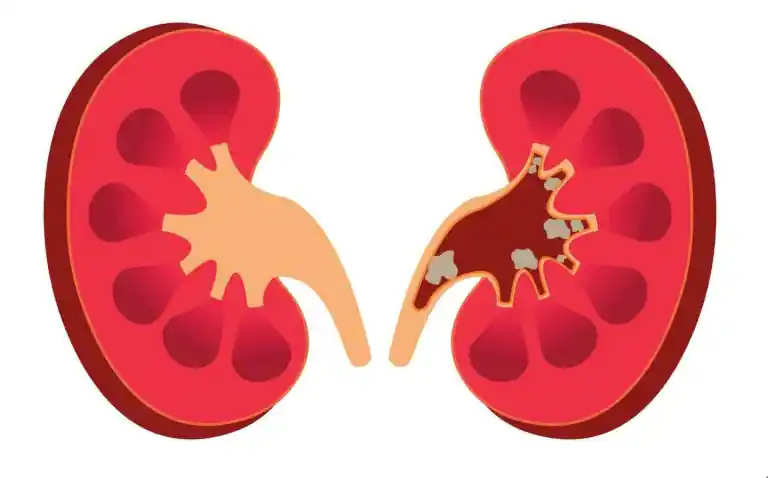 Nephrolitiasis Batu Ginjal