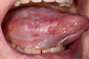 Oral Cancer Kanker mulut