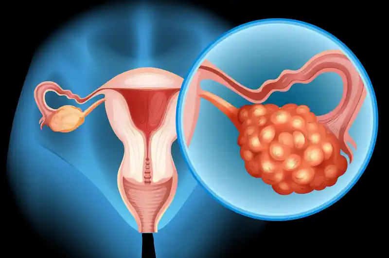 OvarianCancer