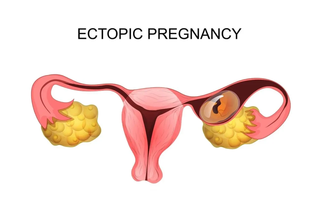 ectopic-pregnancy