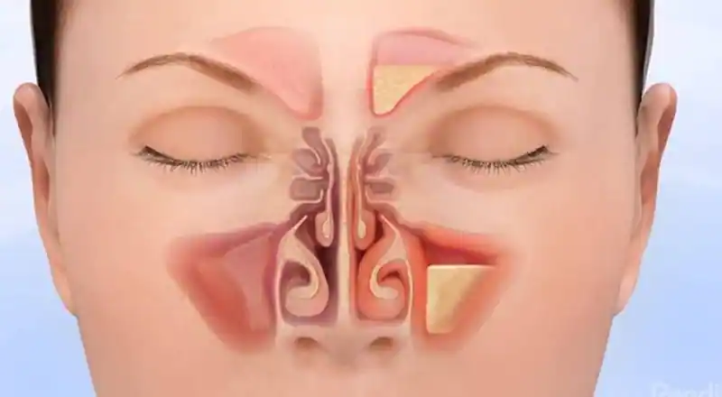 sinusitis